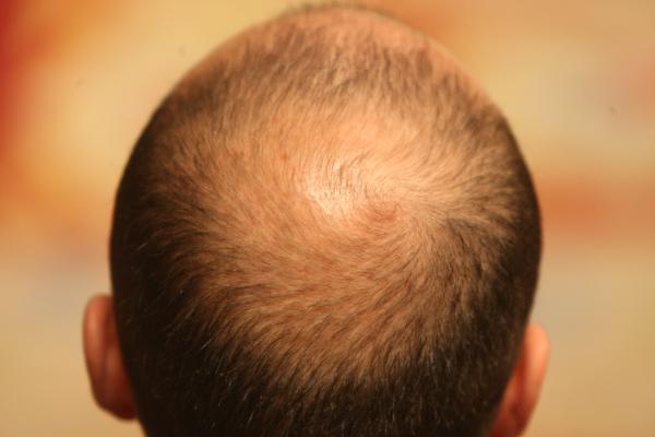 Descubre todo acerca de la alopecia